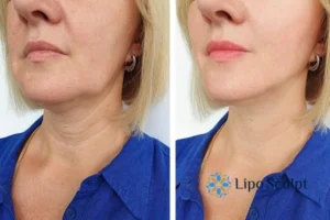 Double chin before and after Hi-Fu treatment 4 Book your double chin treatment Oxfordshire today! We are here to help!