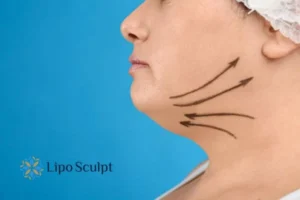 Double chin before and after Hi-Fu treatment 3 Boost your confidence with a Double chin treatment Oxfordshire