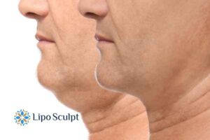 Double chin before and after Hi-Fu treatment 2 Double chin treatment Oxfordshire from Lipo Sculpt - feel more confident today!