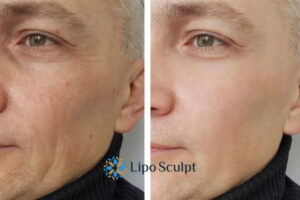 How to Fight Aging Symptoms 3 Fight Aging Symptoms Oxfordshire With HIFU and Morpheus8 Today!