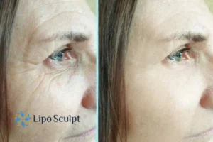 How to Fight Aging Symptoms 2 Do you want to Fight Aging Symptoms Oxfordshire? Contact Lipo Sculpt today!