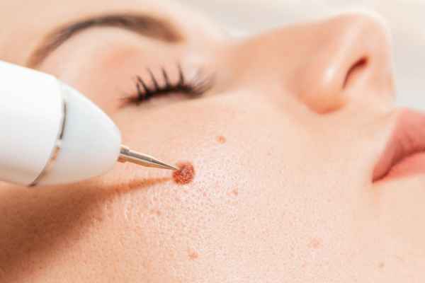CryoPen: 5 Skin Concerns It May Be Used to Treat 3 What actually happens during a CryoPen treatment Oxfordshire?