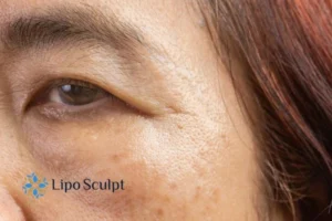 Cryopen: The Revolutionary Treatment for Age Spots Unveiled 2 Are age spots Oxfordshire giving you low self esteem? Contact us today!