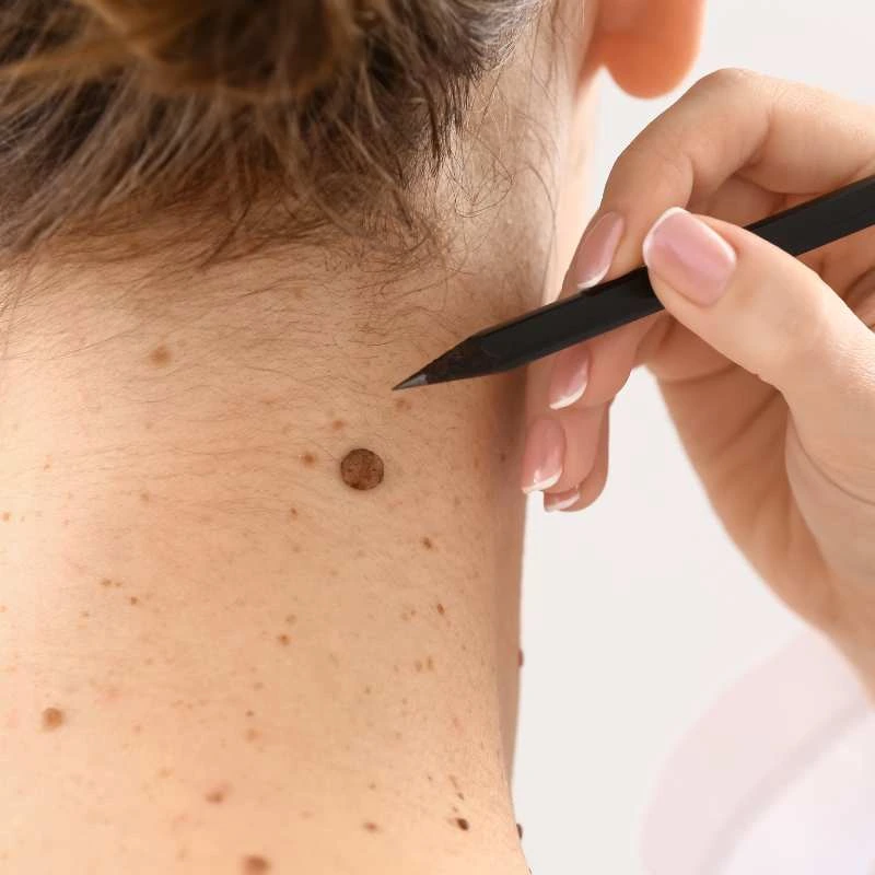 How to Support Your Body During Pregnancy for Faster Postnatal Recovery 5 See our lesion removal prices Oxfordshire - call today for a free quote