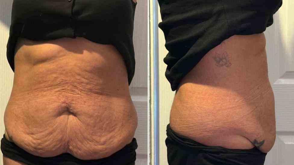 Lost the Weight but Not the Loose Skin? What You Should Know 1 Is It Definitely Loose Skin Oxfordshire?